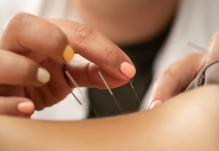 calgary acupuncturist treating a woman