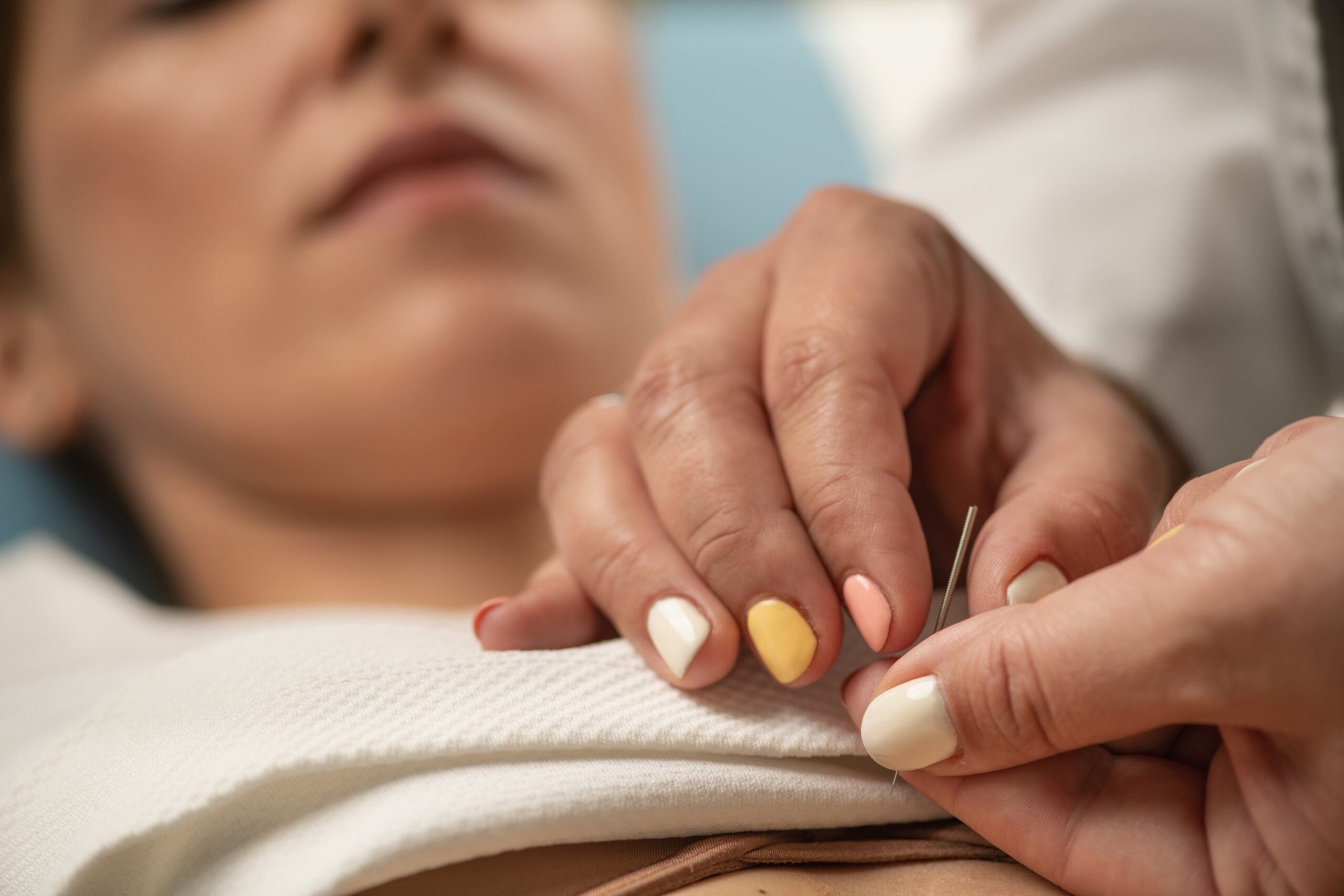 woman receiving acupuncture in calgary